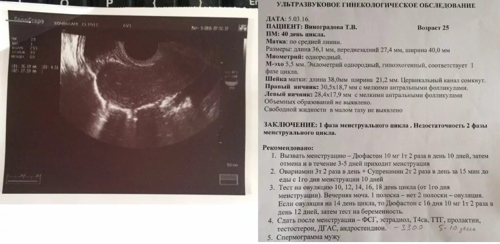 Эндометрий на 10 день цикла УЗИ. Эндометрий 14 5 мм при беременности. Эндометрий 3,6 мм при беременности. Эндометрий на 5 неделе беременности.