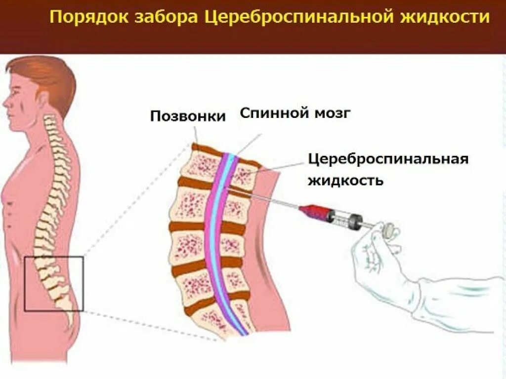 Анестезия в спинной мозг.