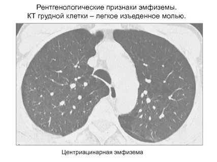 Эмфизема кт признаки