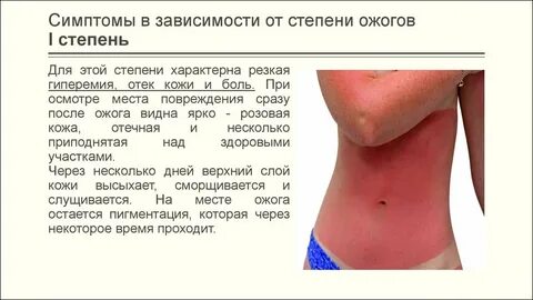 Какие признаки характерны для ожога 2 степени