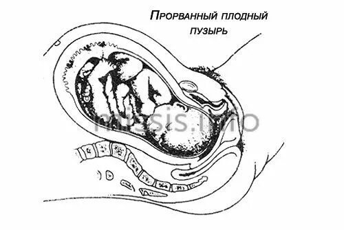 Разрыв плодных. Оболочки плодного пузыря. Плодный пузырь у беременной.