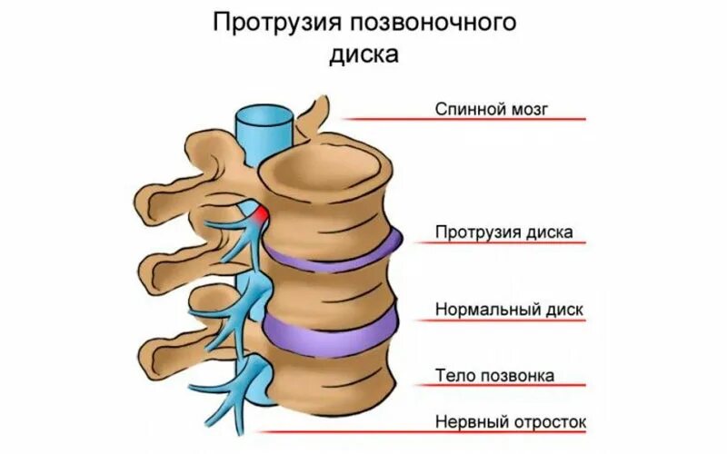 Протрузия шейного отдела позвоночника симптомы. Протрузии дисков позвоночника поясничного отдела. Симптомы протрузии позвоночника. Протрузия межпозвонковых дисков поясничного отдела. Протрузии диска грудного отдела позвоночника.