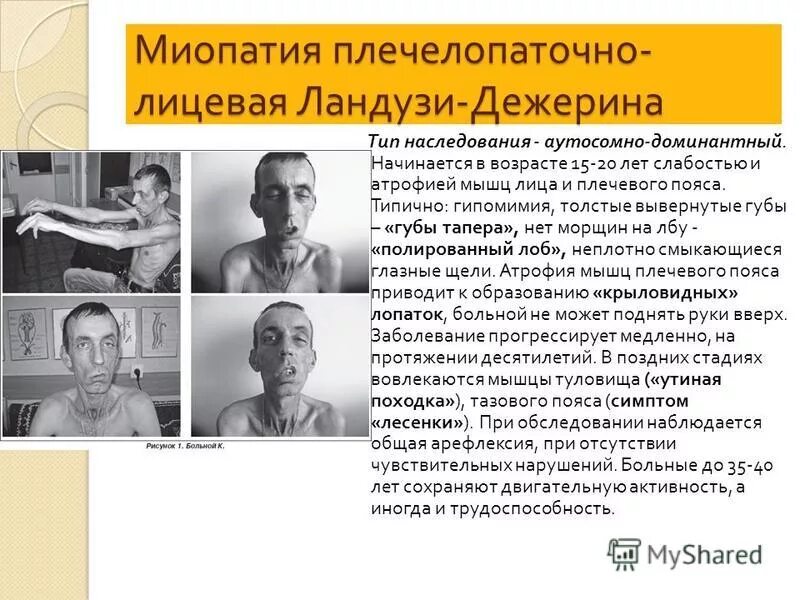 дистрофия ландузи-дежерина. плечелопаточно-лицевая форма ландузи-дежерина. мышечная дистрофия ландузи-дежерина. ландузи дежерина. ландузи дежерина.