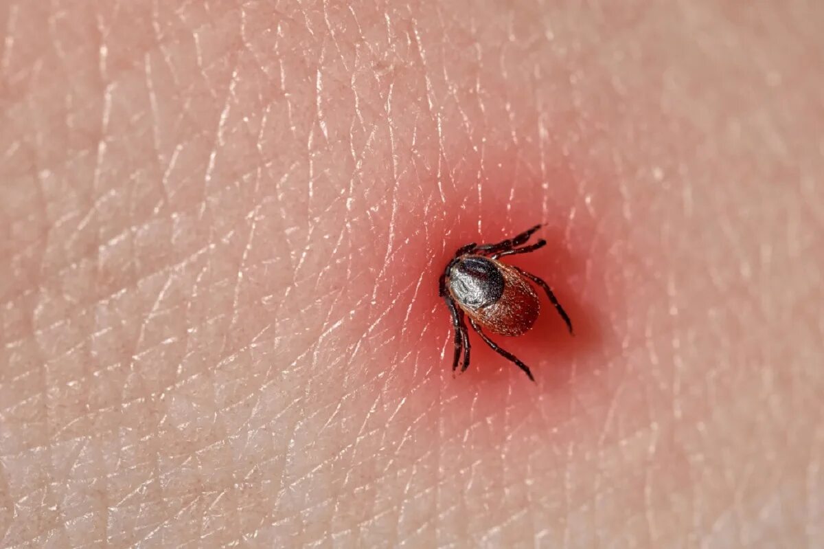Энцефалит после клеща симптомы. Ixodes ricinus. иксодовый клещевой боррелиоз. клещ энцефалитный присосался.