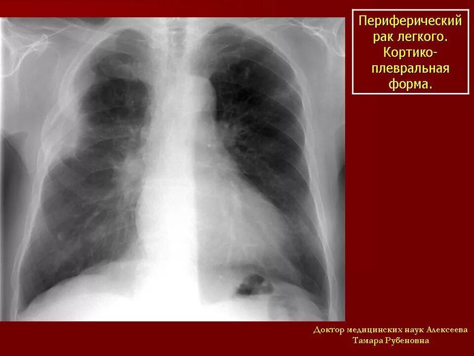 Perifericheskiy rak Legkovo na rentgenogramme. Флюорография опухоль в легких. Онкология на флюорографии. Опухоль в легких на рентгене. Признаки периферического легкого