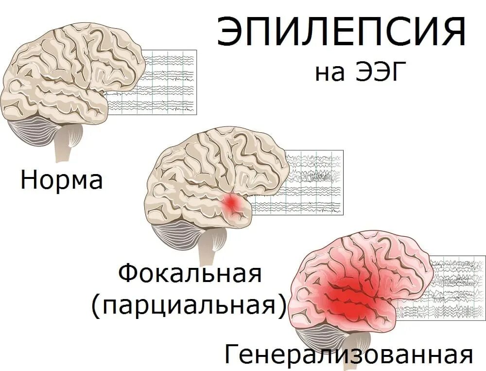 Этапы приступа эпилепсии. Эпилепсия у здорового. Хроническая эпилепсия. Эпилептический приступ симптомы. Эпилепсия у детей симптомы.