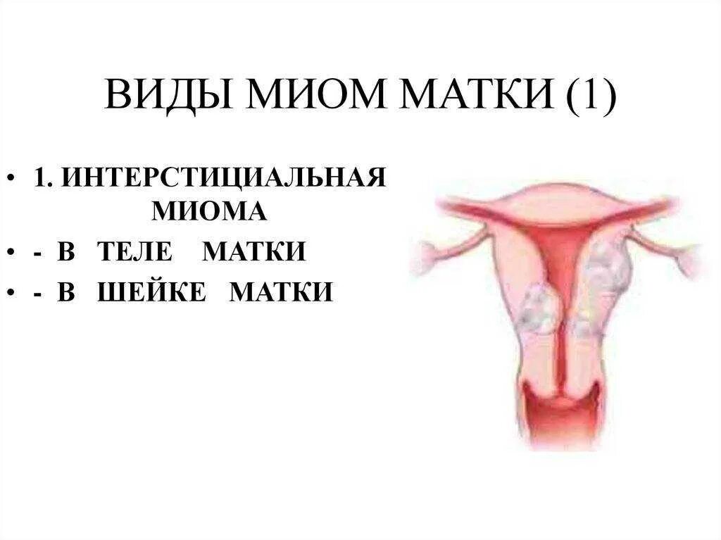 Лейомиома матки что это. Миома матки, фибромиома матки. Диагноз миома матки по мкб 10. Интерстициальная миома матки что это такое.