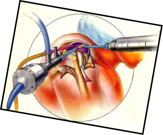 Артроскопическая субакромиальная декомпрессия. Операция артроскопия коленного сустава. Артроскопическая пластика коленного сустава. Операция Банкарта артроскопия. Операции на коленном суставе стоимость