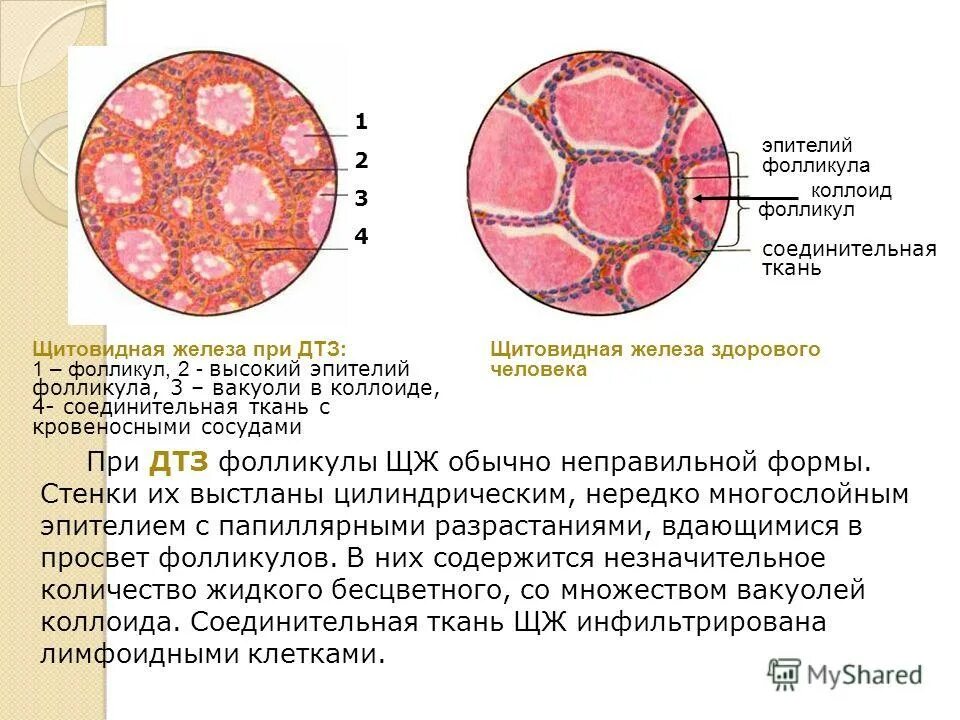 Коллоид щитовидной железы. Фолликулярные клетки щитовидной железы. Фолликулы щитовидной железы выстланы эпителием. Коллоидная дистрофия щитовидной железы гистология. Гиперфункция щитовидной железы эпителий фолликулов.