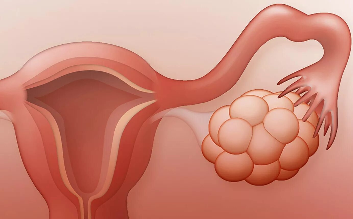 Лечение кисты в менопаузе. Мультифолликулярные поликистоз яичников. Поликистоз яичников макропрепарат. Фолликулярная киста яичника. Текалютеиновые кисты яичника.