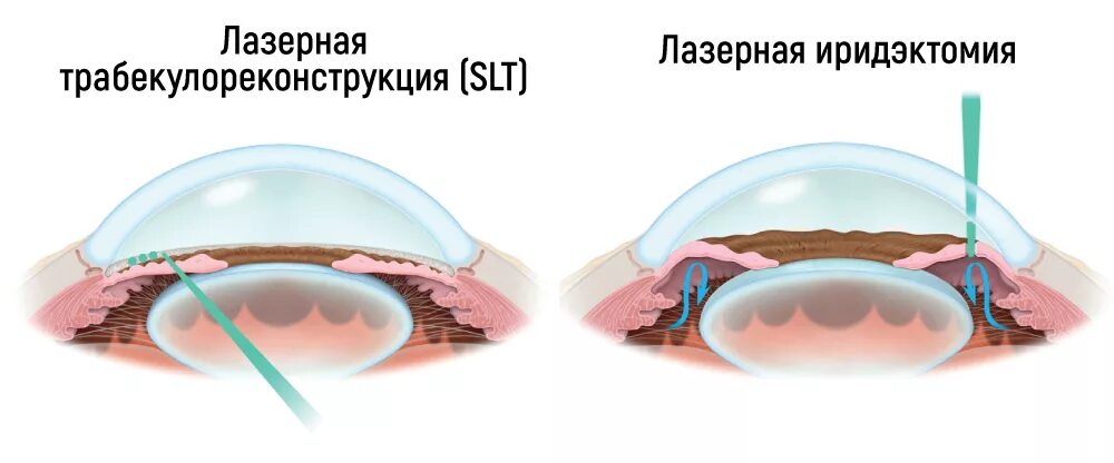 Антиглаукоматозная иридэктомия. Открытоугольной глаукома хирургия. Лазерная иридэктомия глаза. Селективная лазерная трабекулопластика (SLT). Глазная операция глаукомы