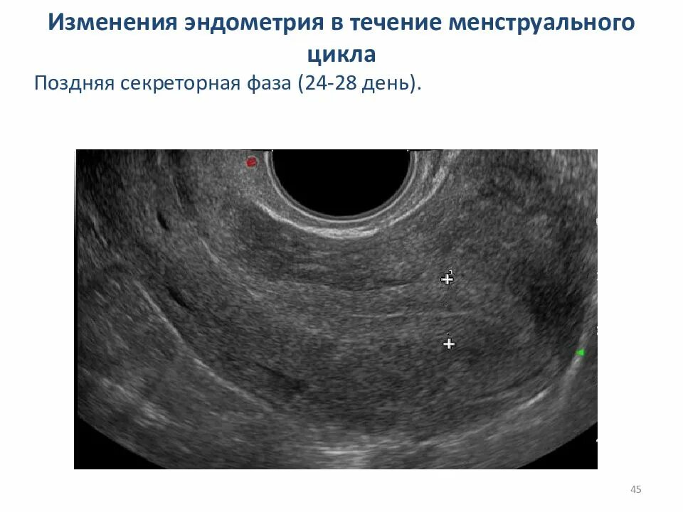 Эндометрий 1 3. Эндометрия 1 фаза. Секреторный эндометрий. Эндометрий на УЗИ по дням цикла. Секреторный эндометрий на УЗИ.