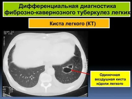 Фиброзно кавернозный туберкулез диагноз