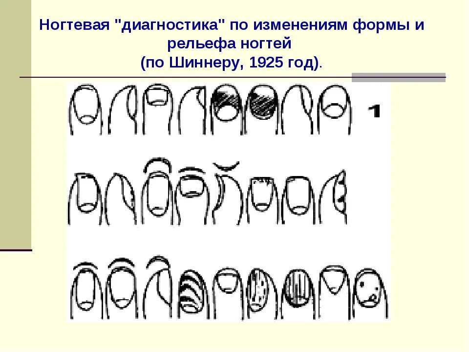 Наличие ногтей на пальцах альвеолярные легкие. Наличие ногтей на пальцах альвеолярные легкие. Заболевания по ногтям рук. Заболевания ногтевой пластины. Строение ногтя вид сбоку.