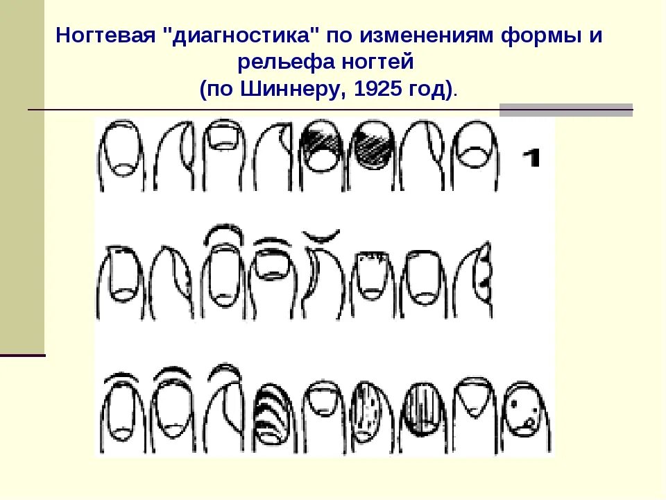 По ногтям определить человеком. Диагностика по ногтям. Состояние ногтевой пластины. Болезни по ногтям на руках таблица.