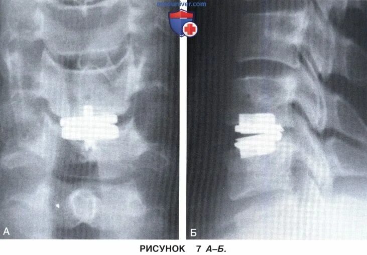 Имплант межпозвонкового диска. Протезы межпозвоночных дисков. Замена межпозвоночного диска. Имплант межпозвонкового диска шейного отдела. Операция по замене позвоночника