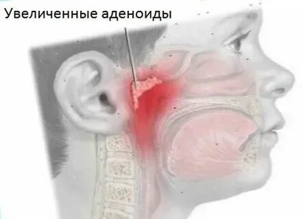 Какие признаки аденоидов