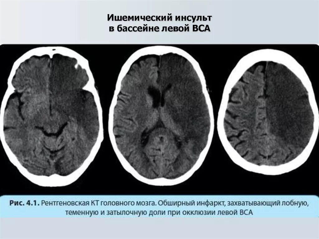 Что такое ишемический инсульт головного мозга. Ишемический инсульт на кт головного мозга. Ишемический инсульт кт и мрт. Полушарный ишемический инсульт. Подострая фаза ишемического инсульта кт.