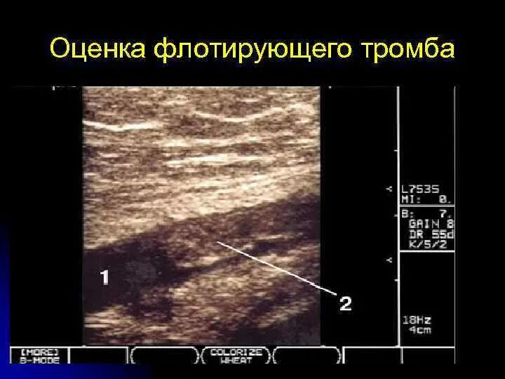 Флотирующий тромб. Флотирующий тромб