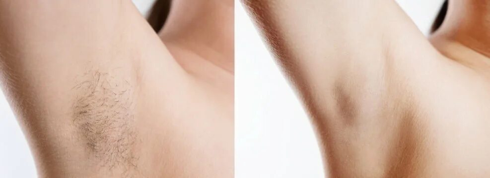 Does Laser Hair Removal Help With Dark Underarms Hotsell podlokot.ru