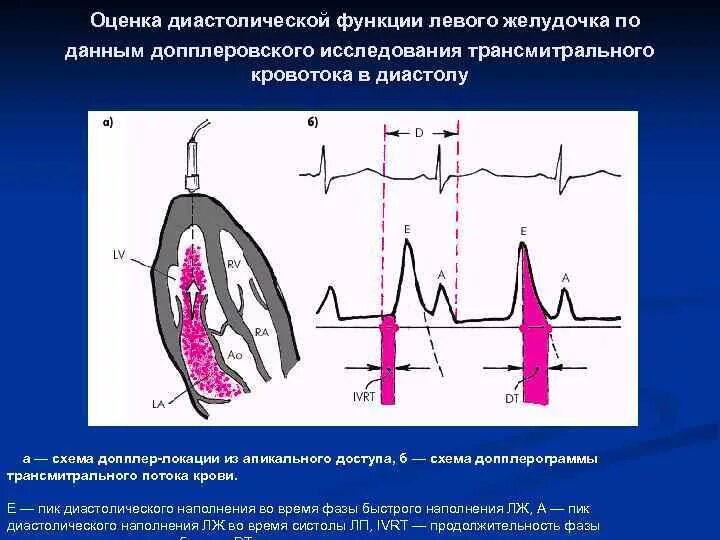 Нарушение диастолической функции левого желудочка по 1. Оценка диастолической функции лж по ЭХОКГ. Оценка диастолической функции левого желудочка. Диастолическая функция левого желудочка е=а. Оценка диастолической функции сердца.