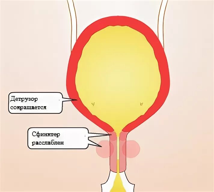 Детрузор мочевого пузыря это. Детрузора мочевого пузыря. Гиперактивность детрузора мочевого пузыря. Лопается мочевой пузырь.