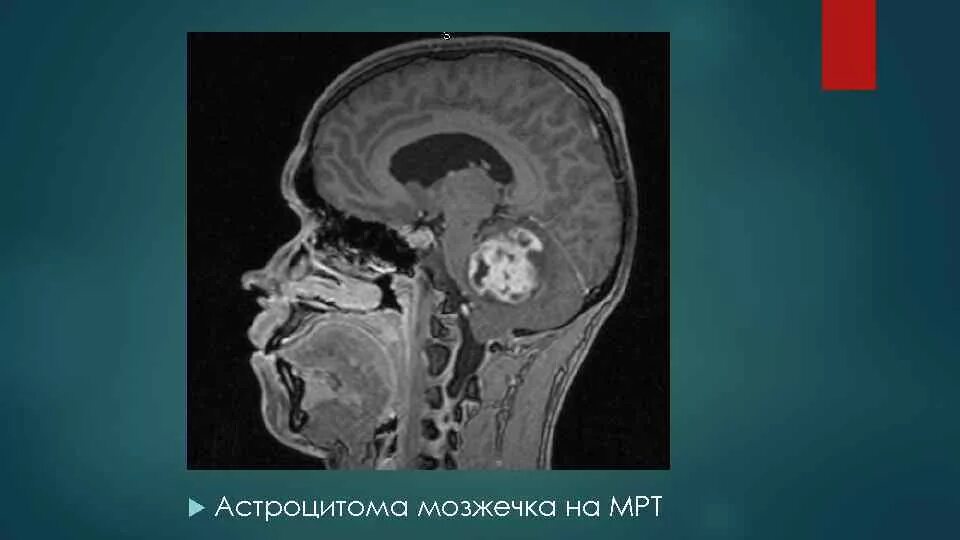 Опухоли мозжечка головного мозга кт. Менингиома намета мозжечка мрт. Астроцитома мозжечка кт. Мозжечковая опухоль