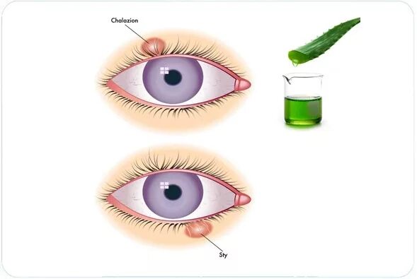 Абсцедирующий халязион. Этапы развития ячменя на глазу.