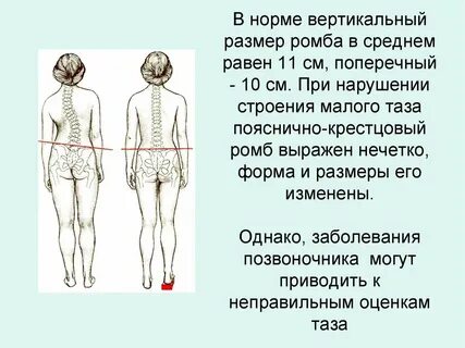 Ромб михаэлиса размеры