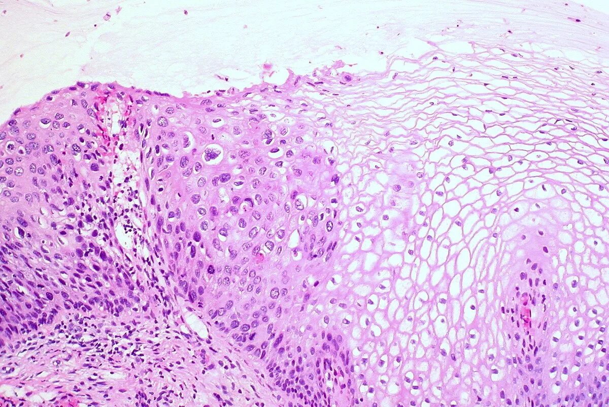Хронический эндоцервицит что это. Дисплазия шейки матки гистология. Койлоцитоз шейки матки гистология. Хронический эндоцервицит гистология. Эндоцервицит шейки матки гистология.