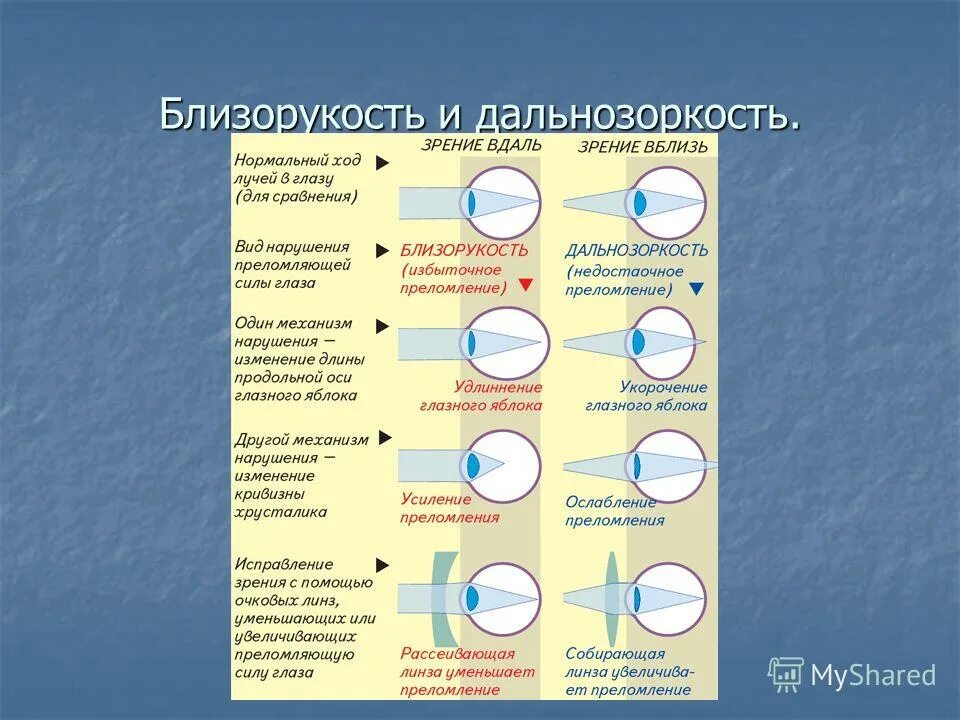 Дальнозоркость это когда. При близорукости преломляющая сила хрусталика. Близорукость и дальнозоркость.