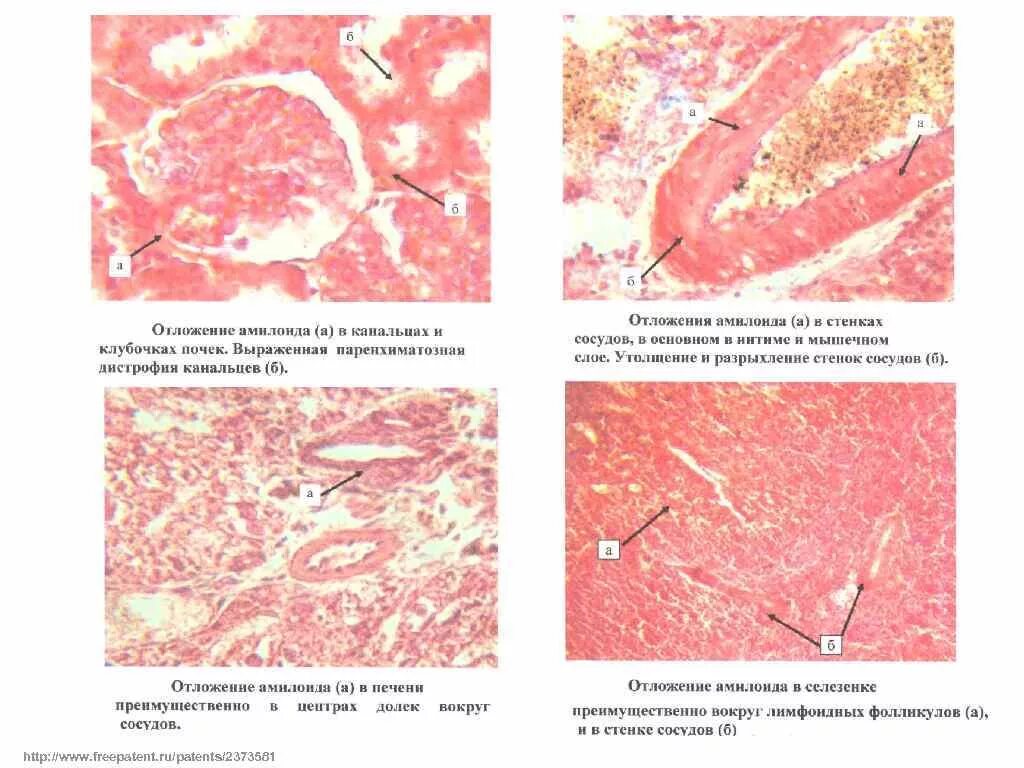 Саговая селезенка. Саговая селезенка патанатомия. Амилоид патологическая анатомия. Амилоидоз печени патанатомия. Амилоидоз почек патанатомия.