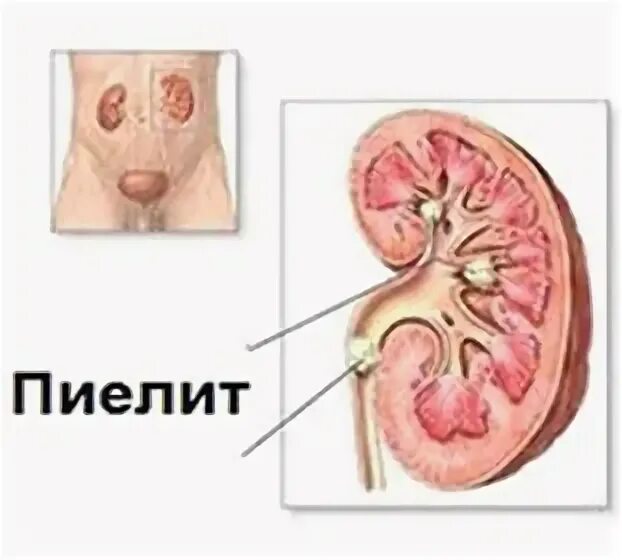 Воспаление почечной лоханки. Пиелит это