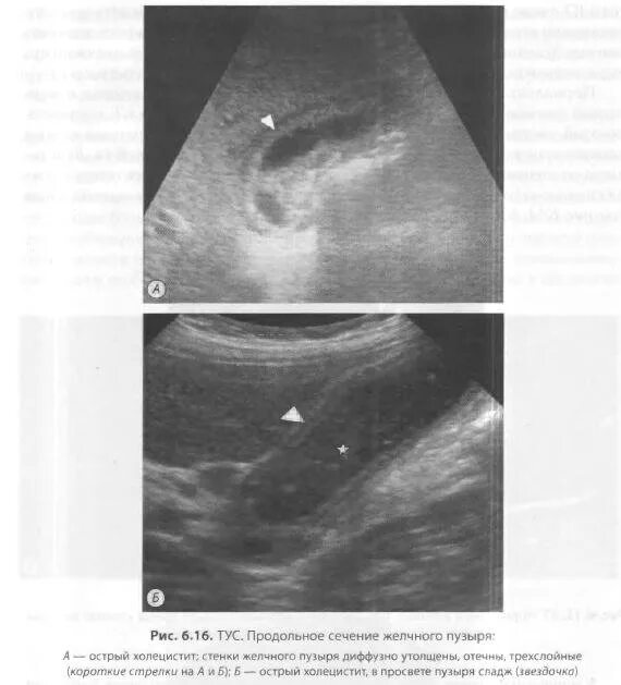 Загиб желчного пузыря в области дна. S образный желчный пузырь узи. Двойной перегиб желчного пузыря. Деформация стенок желчного пузыря. Деформированный желчный пузырь узи.