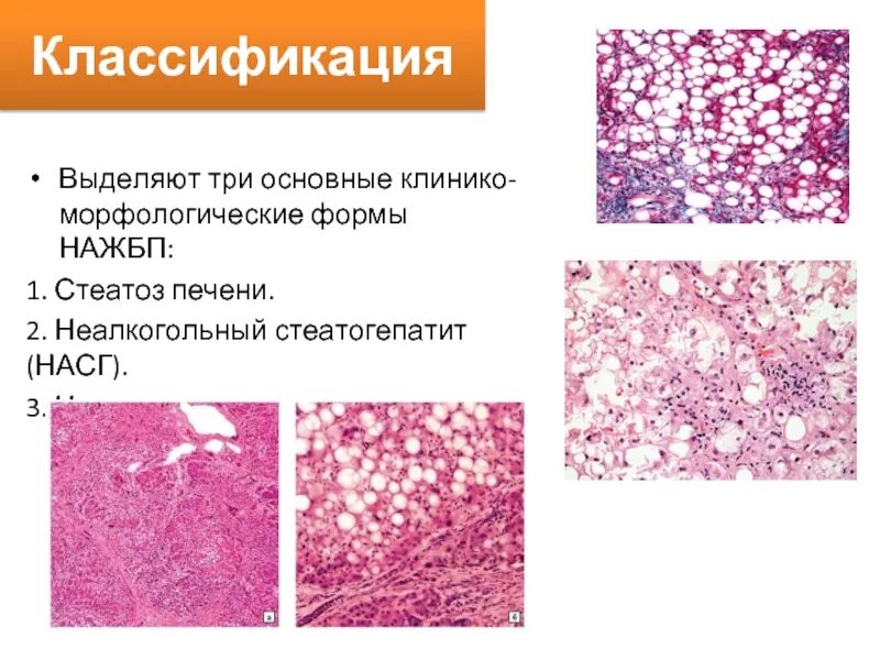 Диффузных изменений печени стеатогепатоз. Стеатоз стеатогепатит. неалкогольная жировая болезнь печени формы. классификация стеатогепатоза.