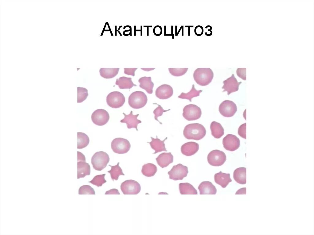 Эхиноциты. Акантоцитоз в мазке крови. Наследственный акантоцитоз. Акантоцитоз в мазке. Акантоциты это эритроциты.