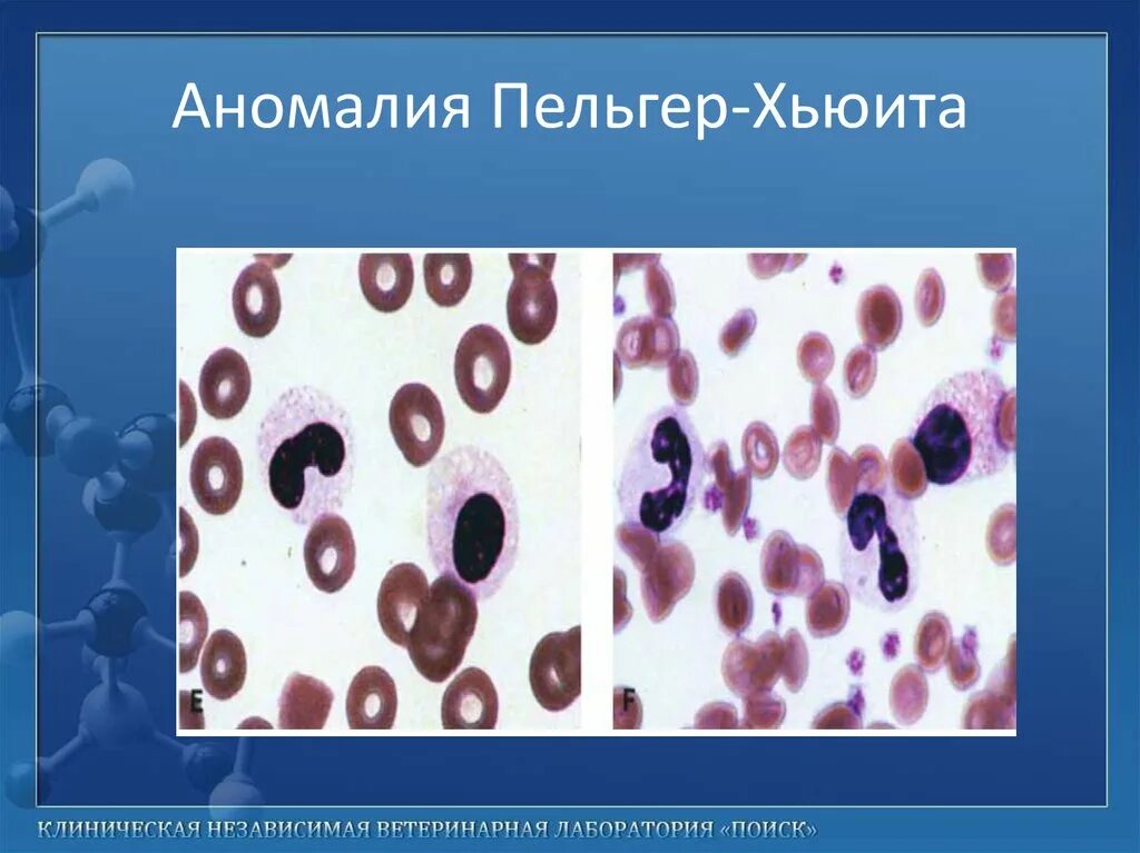 Патология лейкоцитов. Пельгеровской аномалии лейкоцитов. Аномалия лейкоцитов Пельгера. Пельгеровская аномалия нейтрофилов.