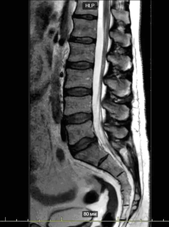 Мрт пояснично крестцового отдела позвоночника цена москва. Мрт пояснично-крестцового отдела позвоночника. Поясничный крестцовый отдел мрт s1. Т1 и т2 мрт пояснично крестцового отдела. Снимок мрт пояснично крестцового отдела позвоночника.
