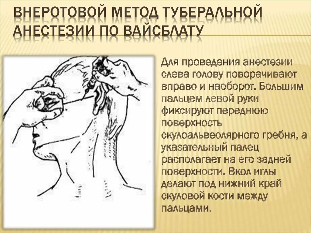 Блокада техника выполнения. Внеротовая туберальная анестезия. Резцовая проводниковая анестезия. Внеротовой метод туберальной анестезии. Стволовая анестезия Вайсблату.