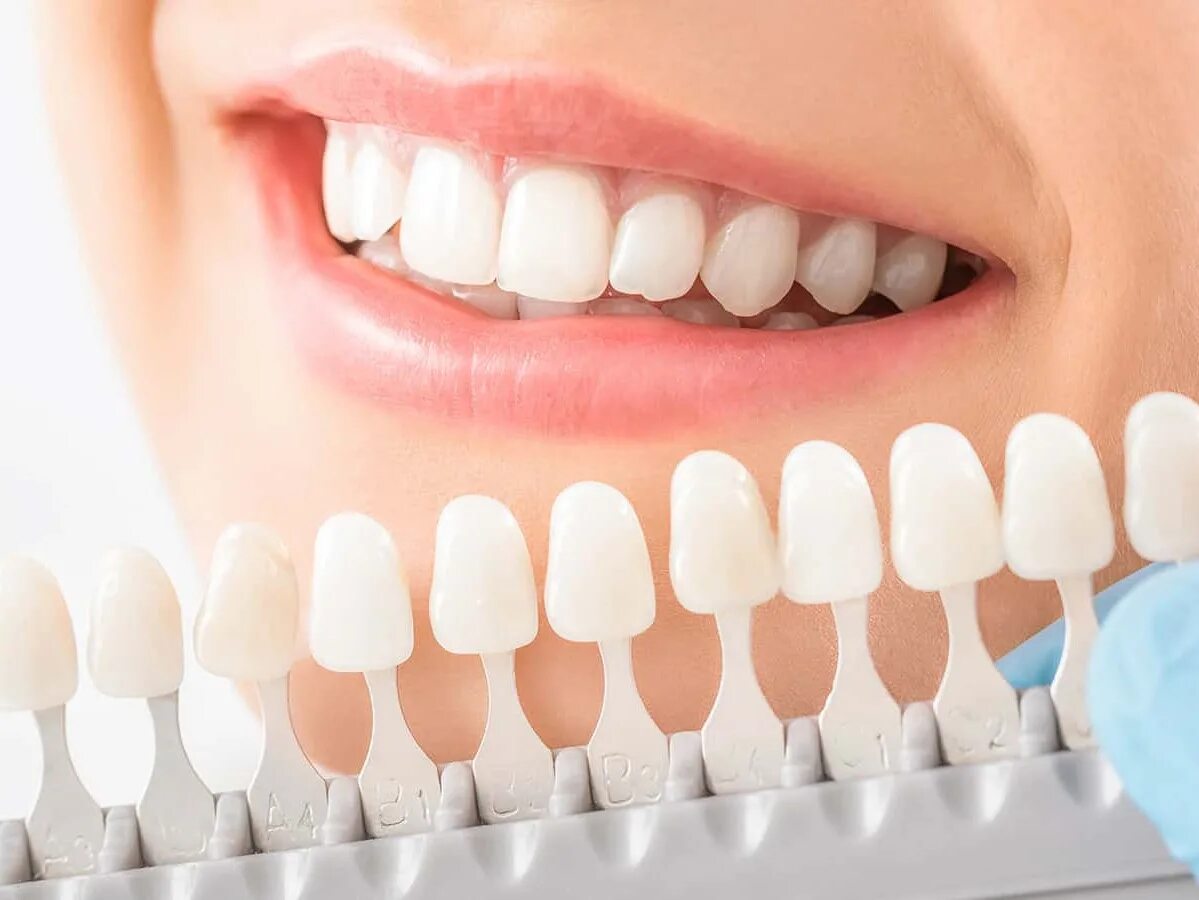 Оттенок b1 по шкале вита. Голливудская улыбка люминиры. Виниры белоруссия. Композитные виниры улыбка. Керамокомпозитные виниры.