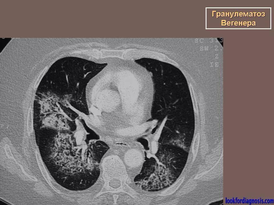 Гранулематоз Вегенера кт легких. Гранулёматоз Вегенера кт легких. Болезнь Вегенера кт легких. Васкулит вегенера