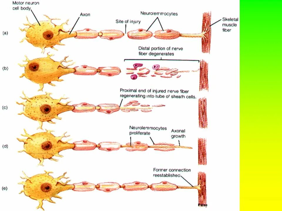 Регенерация нервного волокна схема. Регенерация нервных волокон после повреждения. Дегенерация периферического нерва. Регенерация нейронов гистология схема.