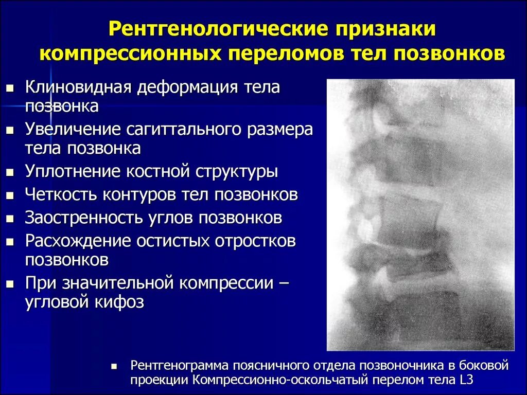 Трещина симптомы лечение. Степени компрессионных переломов позвонков. Степени компрессионных переломов позвонков рентген. Перелом тела позвонка клиника. Компрессионный перелом позвонка степени рентген.