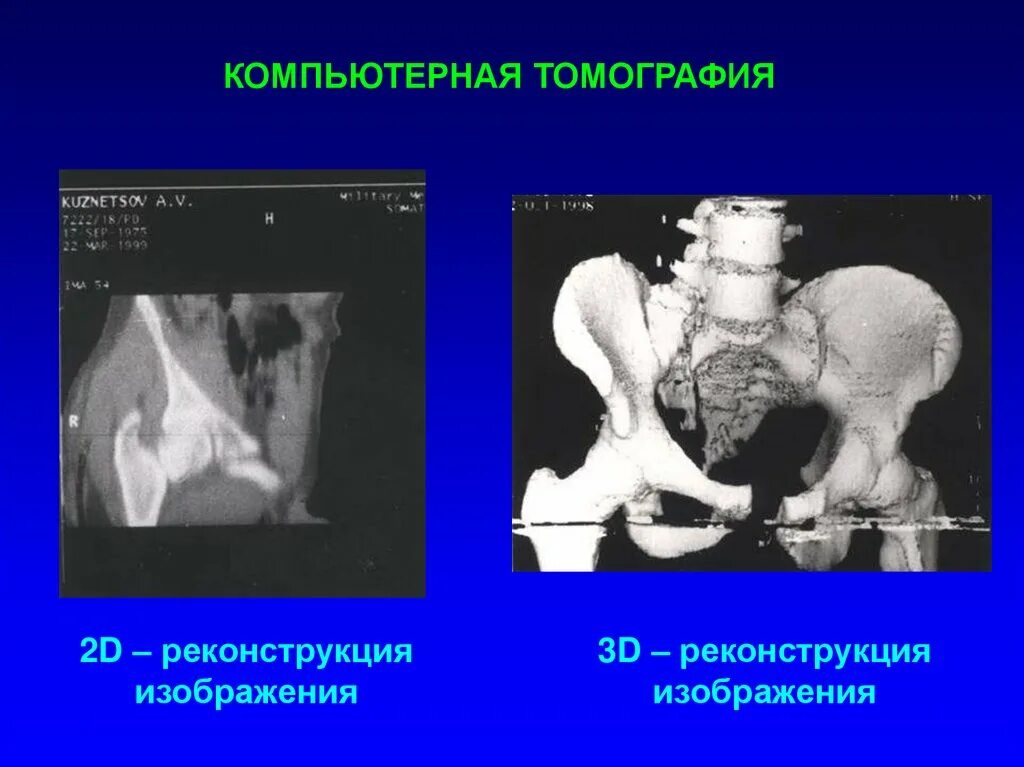 Реконструкция кт изображений. Перелом костей таза кт. Кт перелома таза реконструкция. Повреждение таза и позвоночника травматология. Кт реконструкция