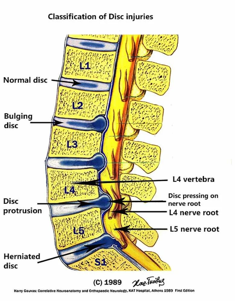 Содержимое межпозвоночного диска. Иннервация фасеточного сустава. Фасеточный позвонок. Радикулопатия поясничного отдела позвоночника. Радикулопатия с1.