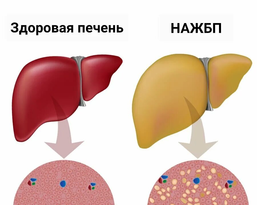 По типу гепатоза что это такое
