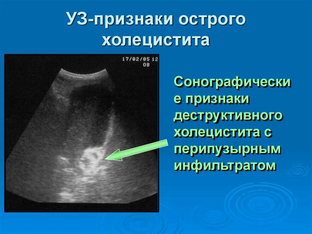 ЖКБ острый калькулезный холецистит. Калькулезный холецистит на УЗИ. Острый калькулезный холецистит на УЗИ. Хронический калькулезный холецистит на кт.