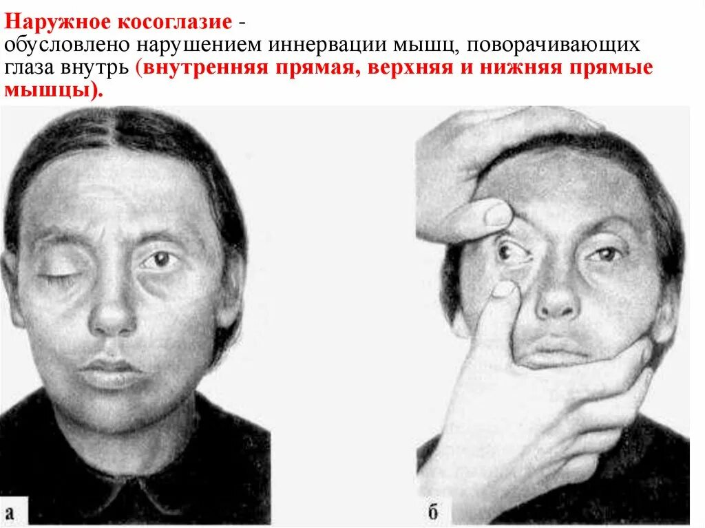 Парез глазных. Парез глазодвигательного нерва. синдром поражения глазодвигательных нервов. птоз верхнего века парез глазодвигательного нерва. симптомы поражения глазодвигательного нерва неврология.
