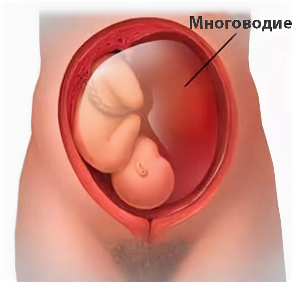 Многоводие при беременности 2 триместр. Многоводие при беременности 2 триместр симптомы. УЗИ многоводие у беременных. Многоводие при беременности УЗИ. Маловодии 38 неделя