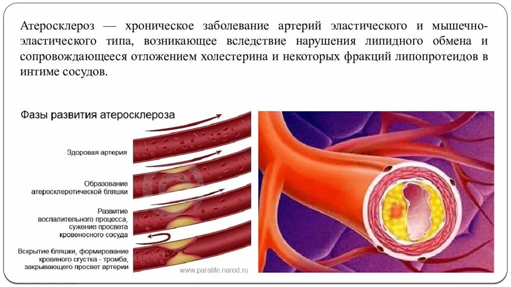 Патогенез атеросклероза сонной артерии. Атеросклеротическое поражение артерий. Атеросклероз заболевание артерий эластического. Артериальные бляшки в сосудах.